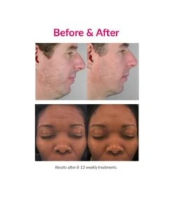 PMD Personal Microderm Elite Pro Black Microdermabrasion -Optimal Kosmetik Geschäft pmd personal microderm elite pro black microdermabrasion 1 stk 811485031454 visual2